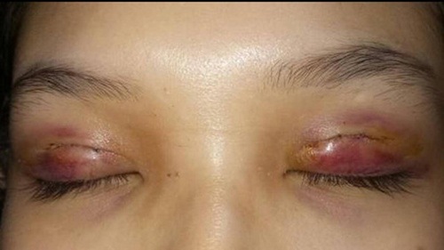 Nguyên nhân mắt bầm tím