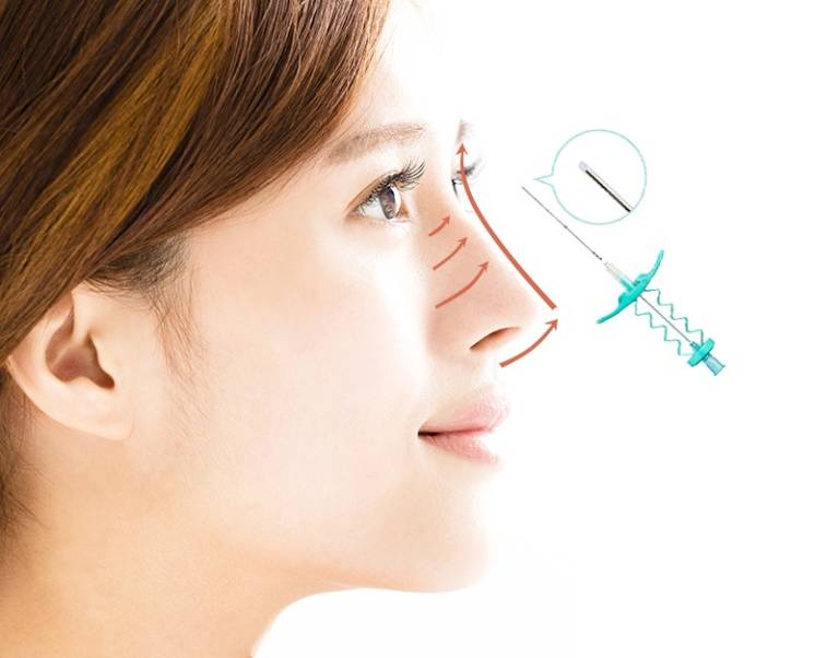 Nâng mũi bằng chỉ collagen là gì? Có thật sự an toàn không?