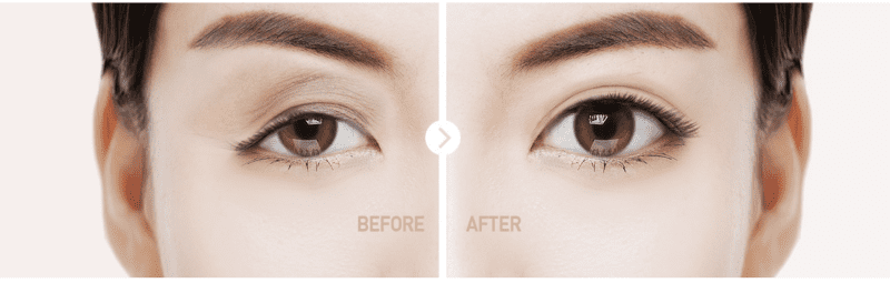 Treo cung chân mày – Phương pháp trẻ hoá vùng mắt nhanh nhất