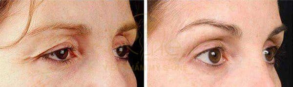 Hình ảnh trước và sau khi cắt mí mắt, treo cung mày