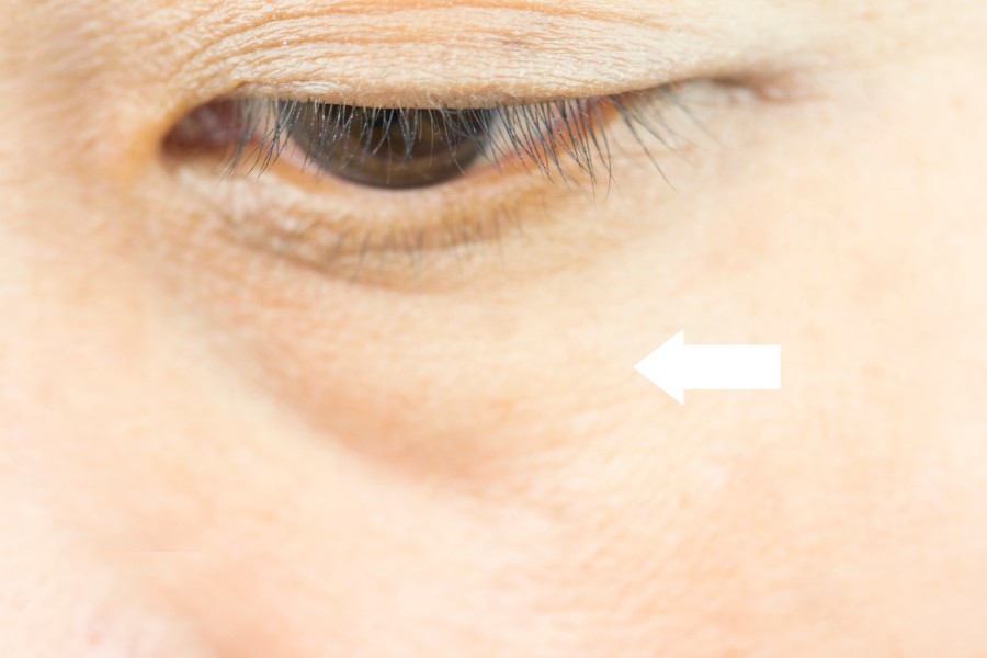 Bọng mắt là tình trạng sưng nhẹ ở vùng da dưới mắt
