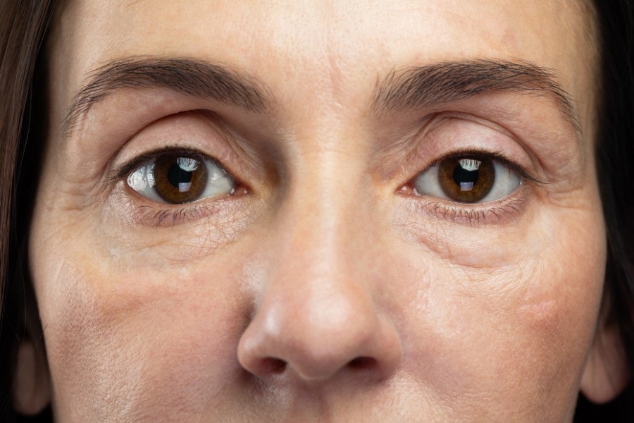 Quá trình lão hóa khiến vùng da quanh mắt chùng nhão, xuất hiện, bọng và quầng thâm mắt