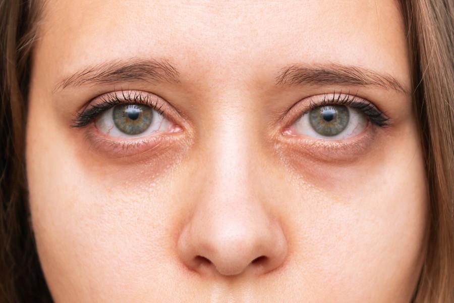 Bọng mắt là tình trạng vùng da dưới mắt sưng nhẹ