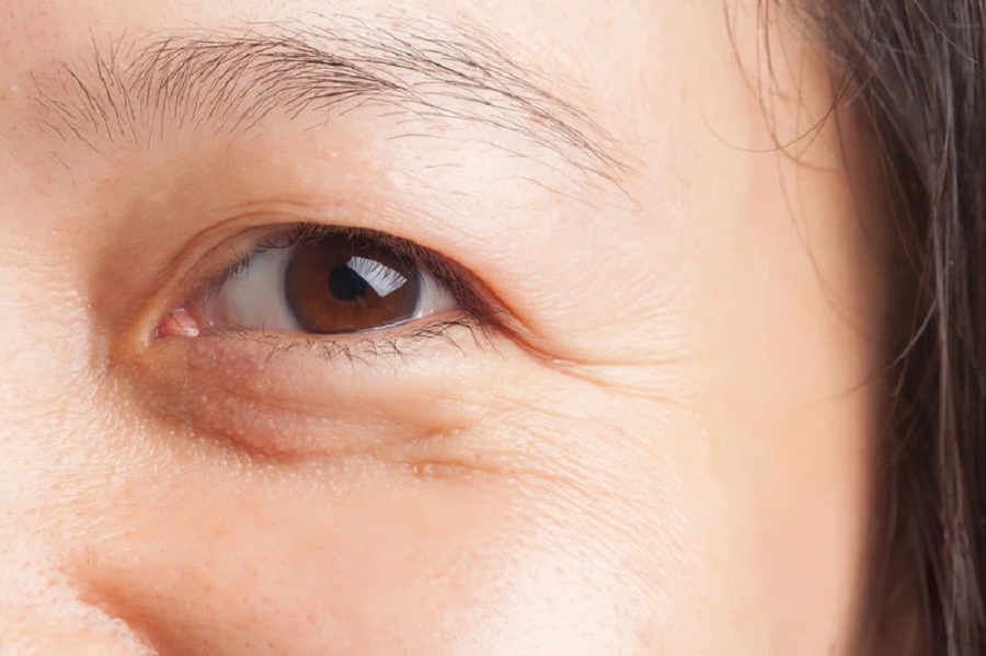 Bọng mắt do lão hóa là một trong những nguyên nhân phổ biến nhất
