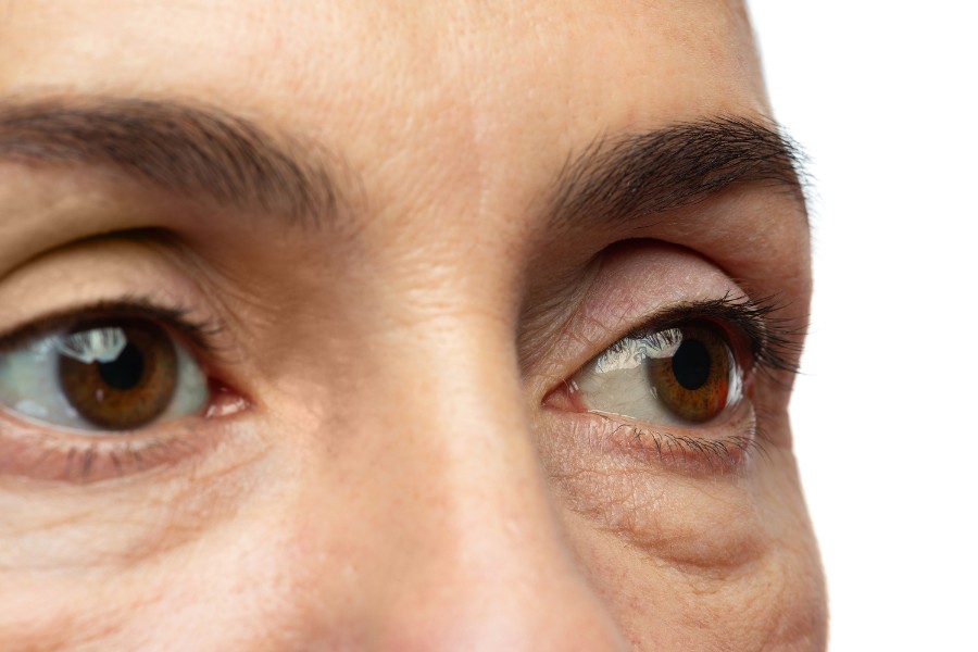 Lấy mỡ bọng mắt phù hợp với những người gặp vấn đề bọng mỡ và da thừa do quá trình lão hóa.