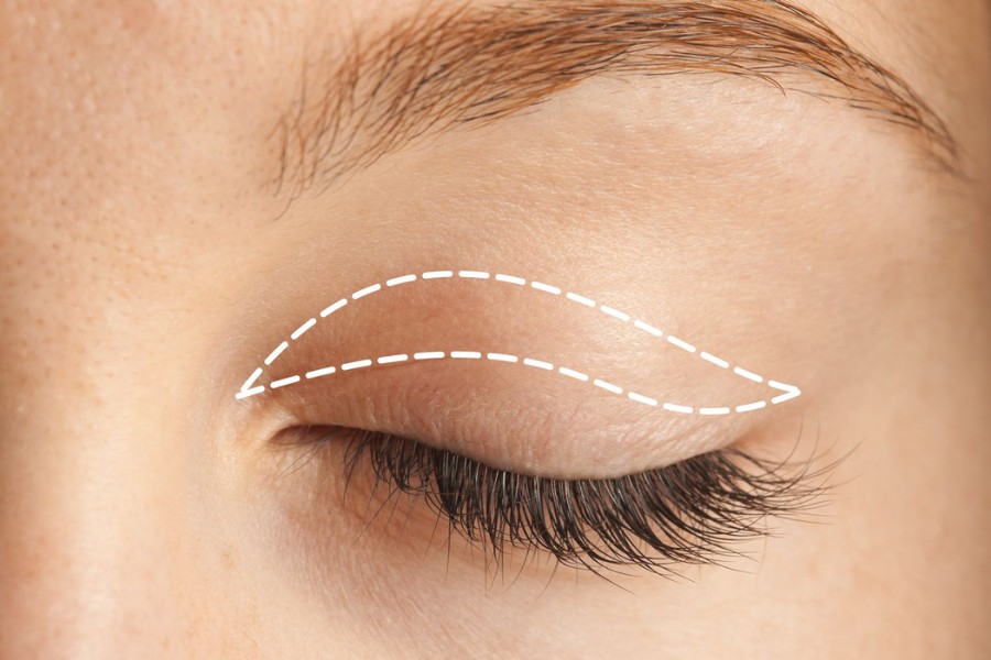 Lấy mỡ mắt nội soi là kỹ thuật thẩm mỹ mí mắt bằng phương pháp nội soi