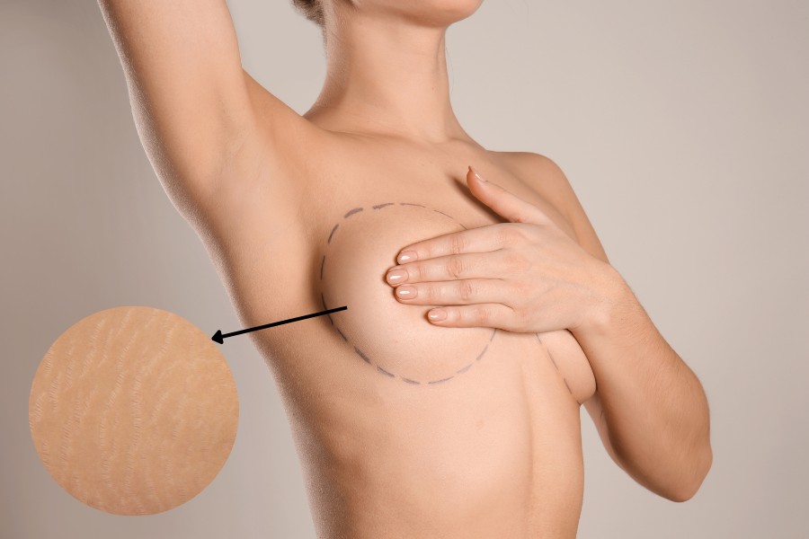 Vùng ngực sau khi nâng có thể gây ra những vết rạn da nhỏ
