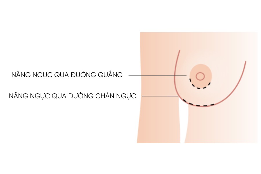Nâng ngực qua đường quầng là phương pháp hiệu quả cải thiện kích thước vòng 1