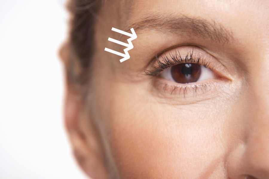 Nguyên nhân gây mỡ mí mắt trên phổ biến nhất chính là quá trình lão hóa