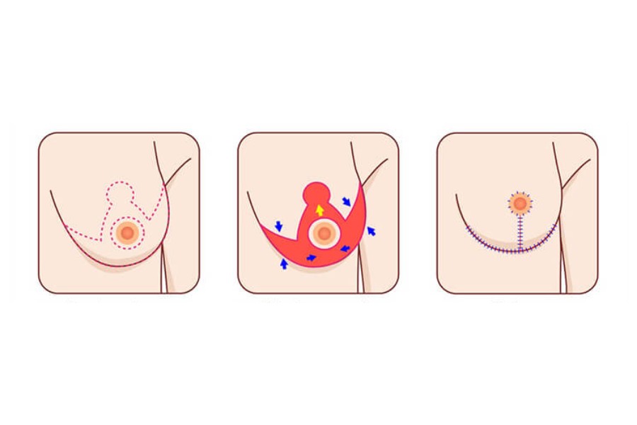 Quy trình chi tiết của quá trình phẫu thu nhỏ ngực