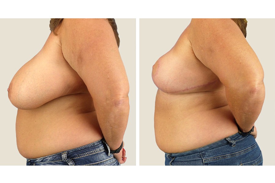 Phương pháp cắt bỏ một phần vùng ngực phì đại dành cho trường hợp phì đại nặng