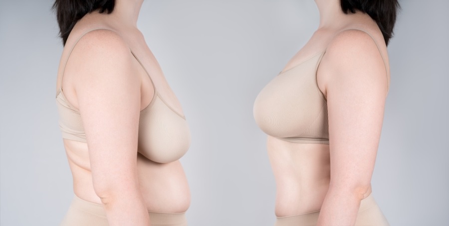 Thu nhỏ ngực có thể là một phương án phẫu thuật thẩm mỹ an toàn