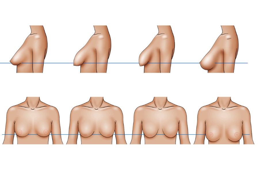 4 cấp độ ngực sa trễ thường gặp