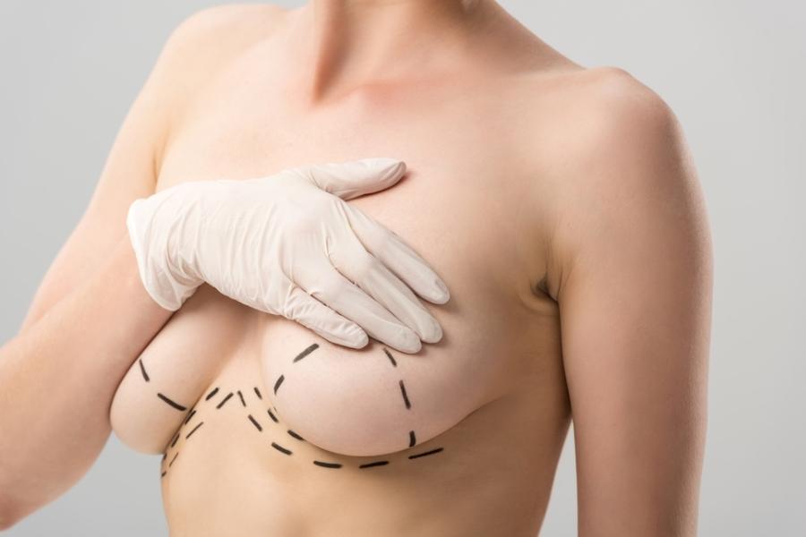 Phương pháp nâng ngực nội soi từ đường quầng vú