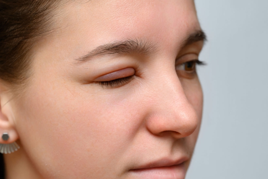 Những yếu tố ảnh hưởng đến nhấn mí mắt sưng bao lâu