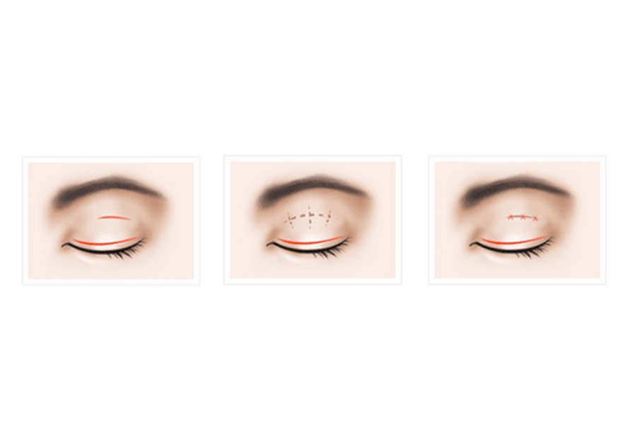 Bấm mí đa điểm Hàn Quốc là phương pháp khắc phục khuyết điểm ở mắt hiệu quả