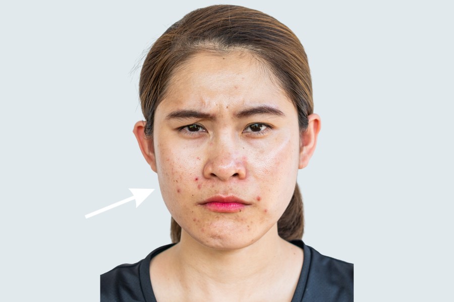 Da mặt sưng tấy, sưng đỏ là hiện tượng thường gặp sau khi căng chỉ da mặt