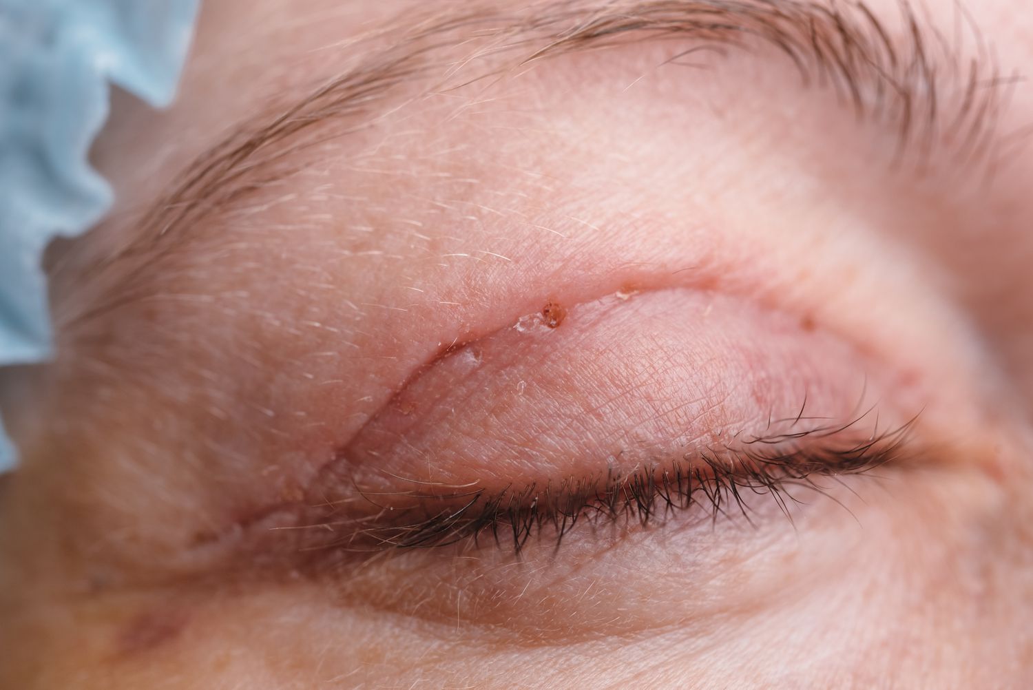 Giá cắt mí mắt phụ thuộc vào kỹ thuật và tình trạng của đôi mắt