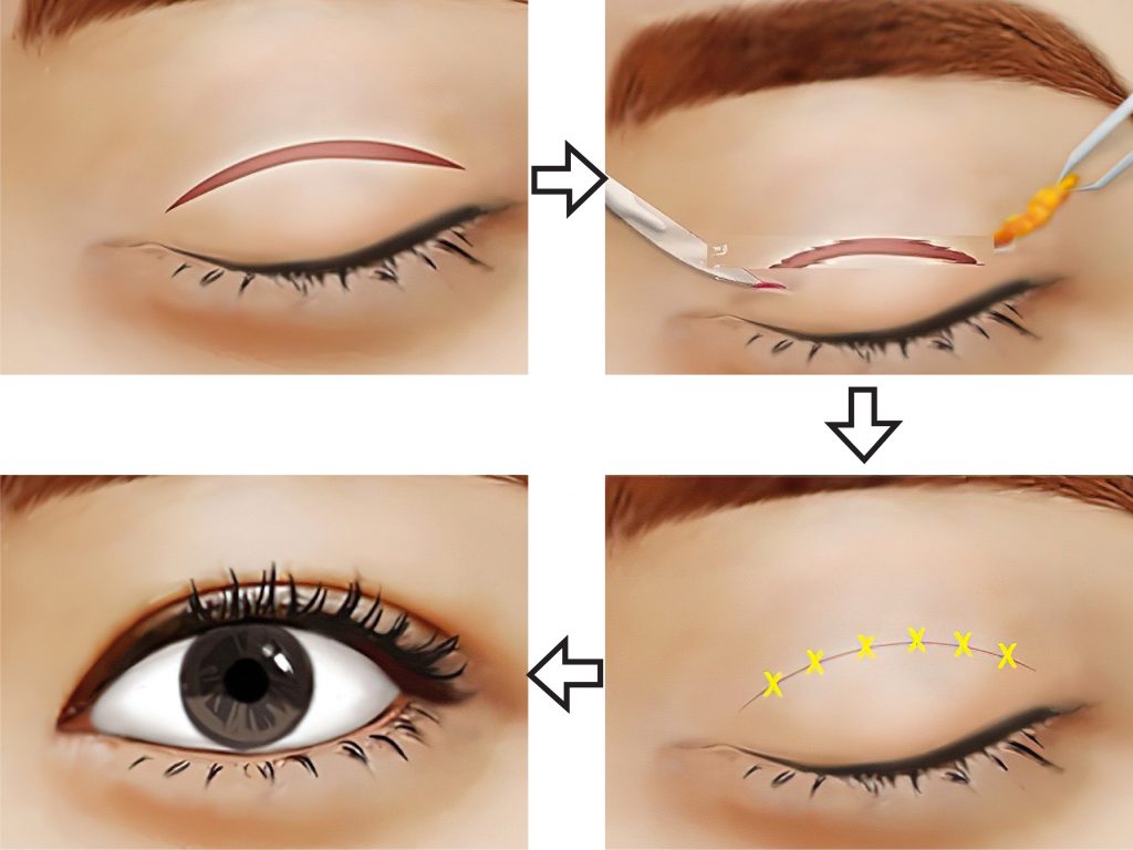 Cắt mí mắt là 1 tiểu phẫu giúp loại bỏ mỡ thừa và da chùng quanh mắt