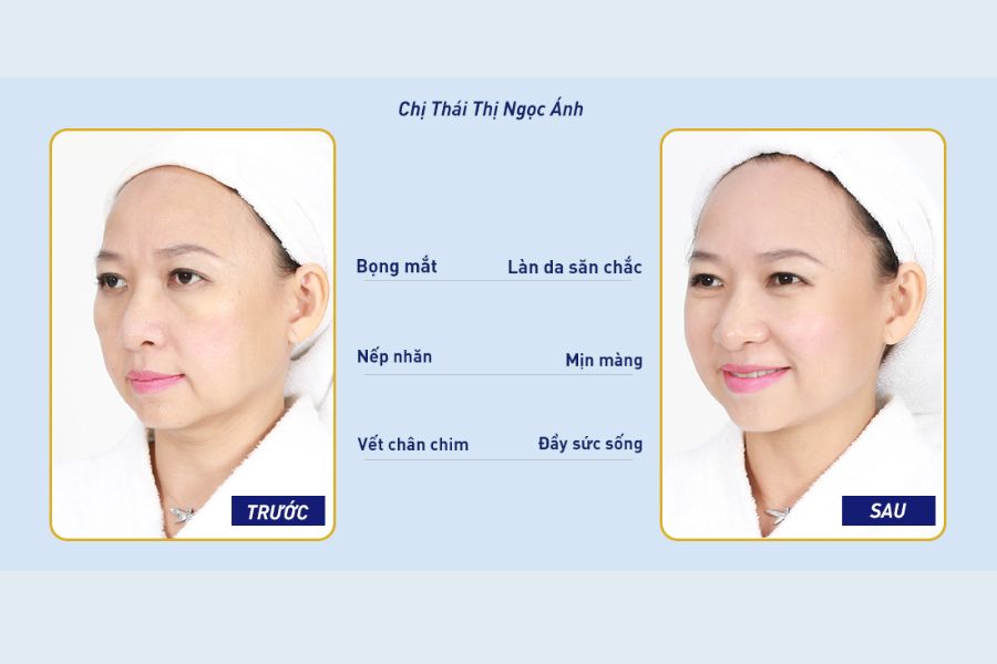 Phương pháp thẩm mỹ mắt tại BVTM Ngọc Dung