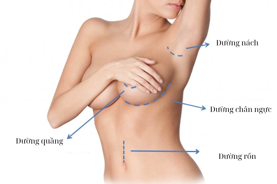 Nâng ngực nội soi qua đường rốn là phương pháp nâng ngực nhiều người lựa chọn