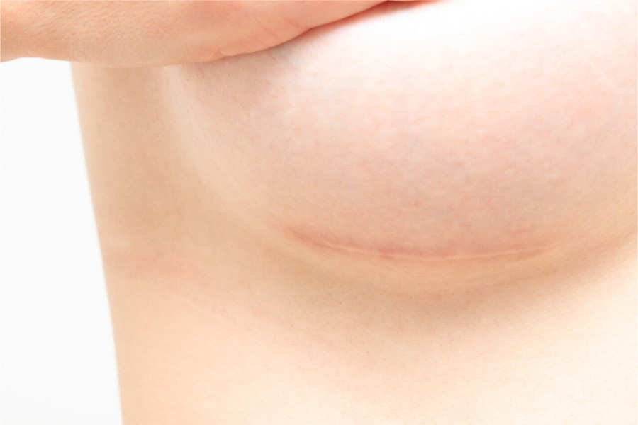 Treo ngực sa trễ có thể để lại sẹo nhưng rất nhỏ