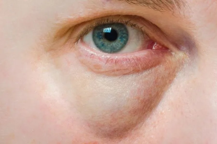 Bọng mắt có thể xuất hiện do cơ thể giữ nước