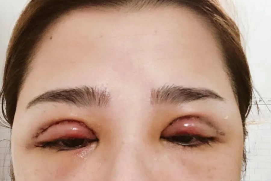 Sau khi cắt mí thường gặp tình trạng mí mắt sưng đỏ
