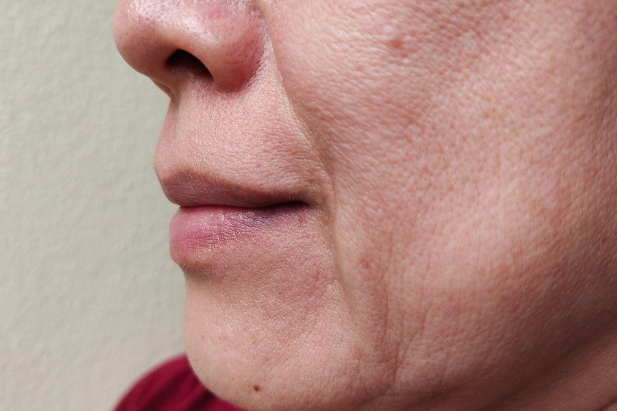 Một số bệnh lý đặc biệt có thể gây ra chảy xệ da mặt và một số vùng da khác