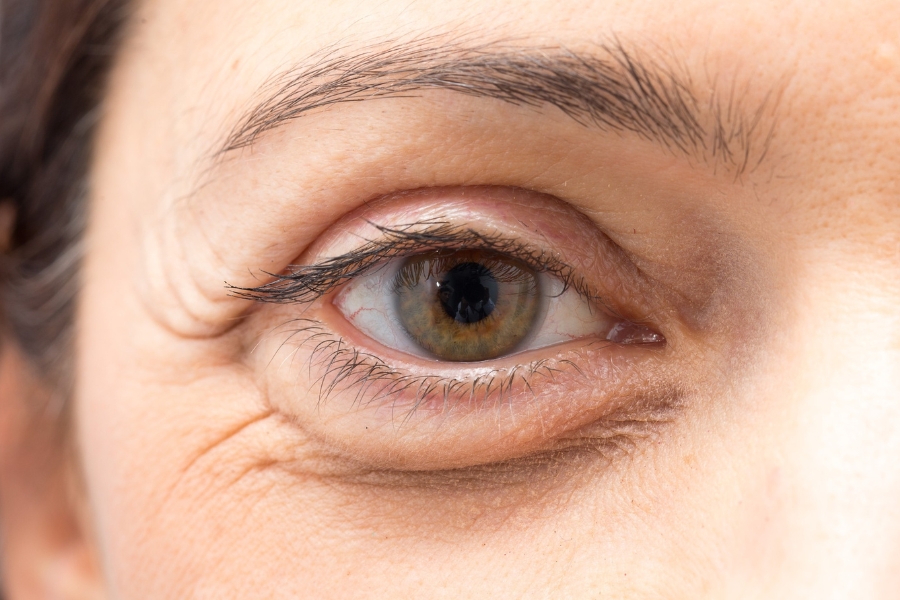 Lão hóa da là một nguyên nhân gây ra bọng mắt