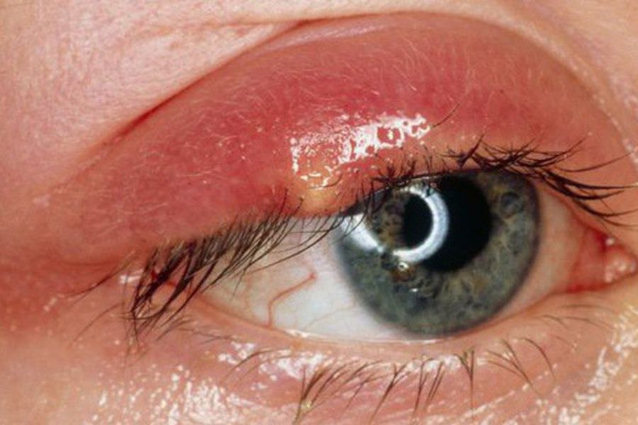 Mắt sưng đỏ, đau nhức và tiết dịch là dấu hiệu nhiễm trùng