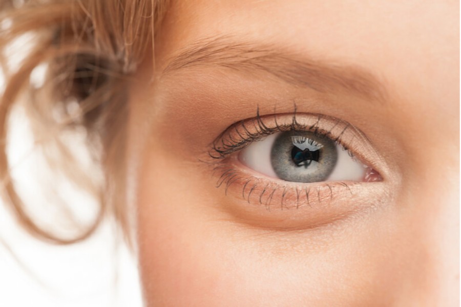 Bọng mắt bẩm sinh có thể thực hiện xóa bọng mắt không phẫu thuật