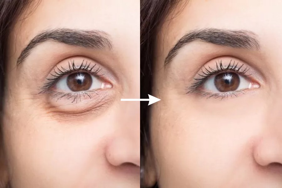 Xóa bọng mắt không phẫu thuật: Cách lấy lại đôi mắt rạng rỡ