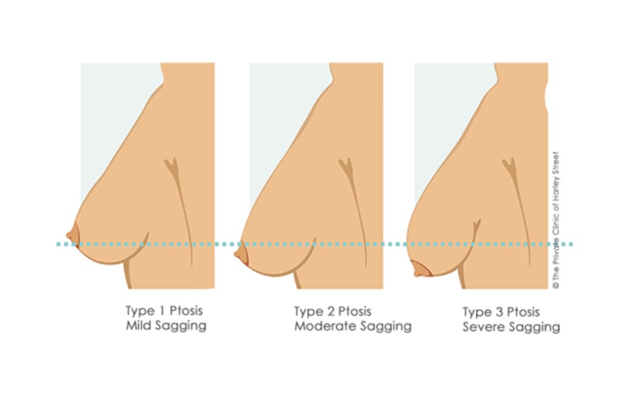 3 mức độ chảy xệ của ngực
