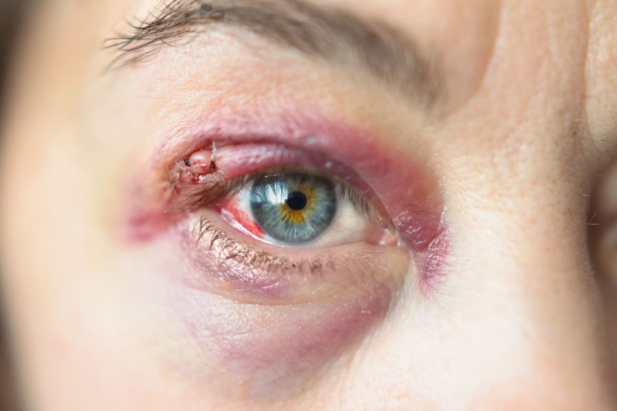Cắt mí hỏng: Nguyên nhân và cách khắc phục mí mắt hỏng