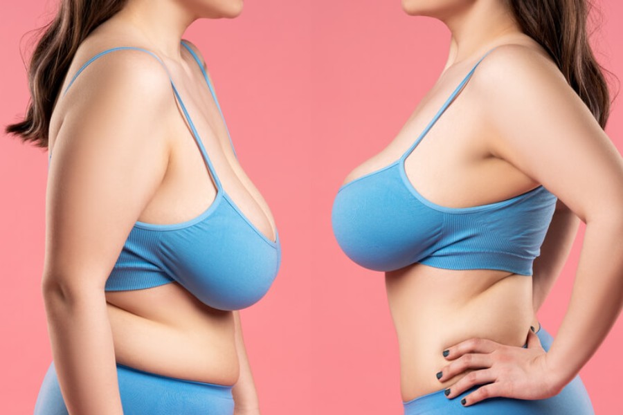 Phẫu thuật nâng ngực cải thiện vòng 1 sau sinh là phương pháp mang lại hiệu quả lâu dài