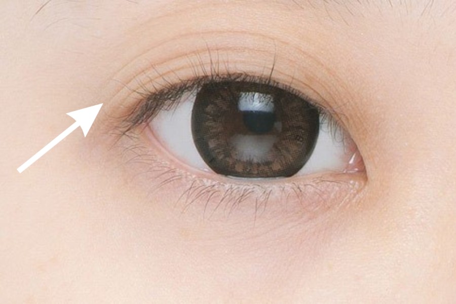 Tình trạng mắt 3 mí có thể xuất hiện do nhiều nguyên nhân