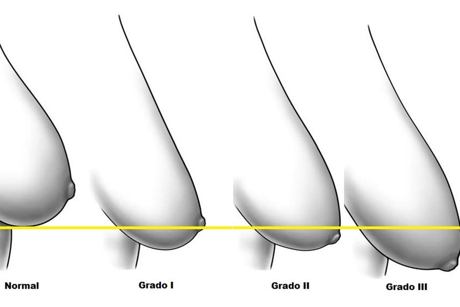 Mức độ sa trễ của ngực ảnh hưởng đến chi phí phẫu thuật