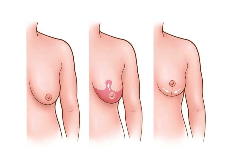 Kỹ thuật được áp dụng tác động đến mức giá phẫu thuật treo ngực